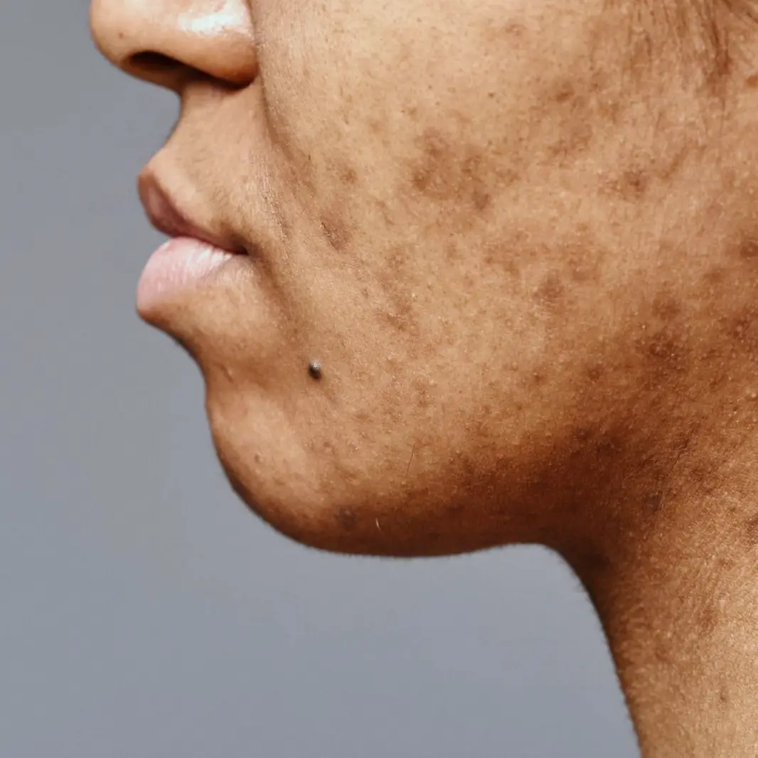 Facial pigmentation and dull skin tone before Inbiotec Amber booster treatment at Kuala Lumpur aesthetic clinic